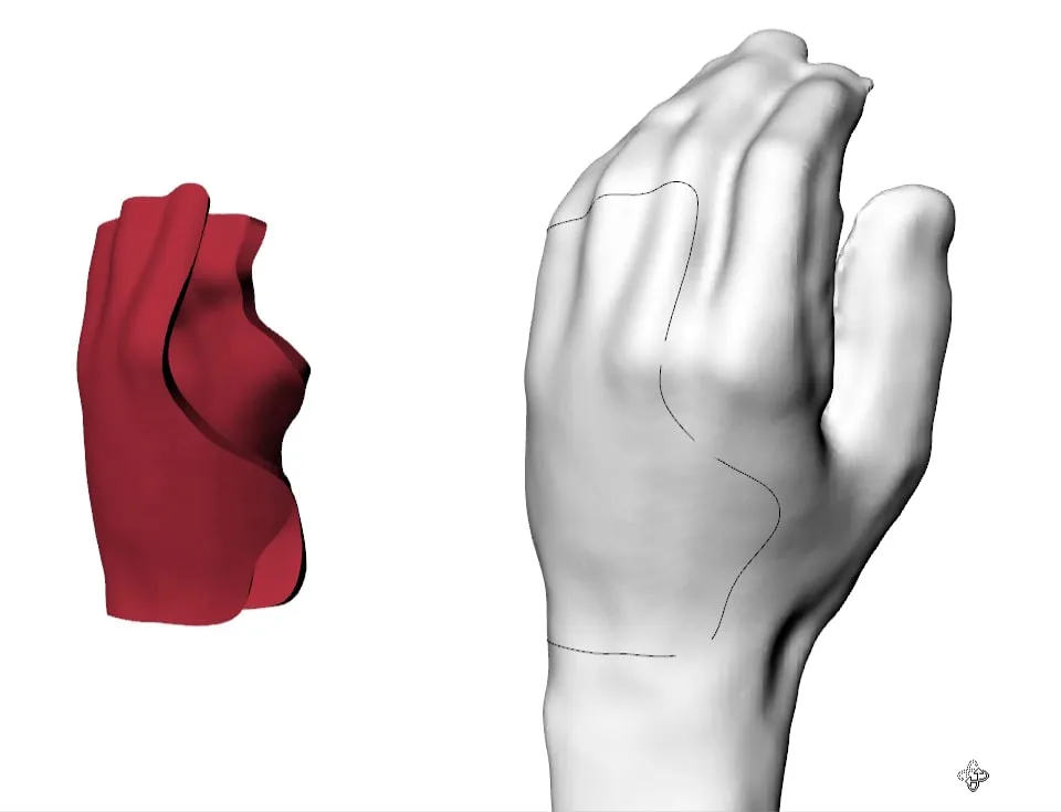 Diseño 3D de la férula sobre el escaneo de la mano
